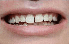 general cosmetic dentistry facial esthetics perfect smile tulsa ok before Lumineers gallery image